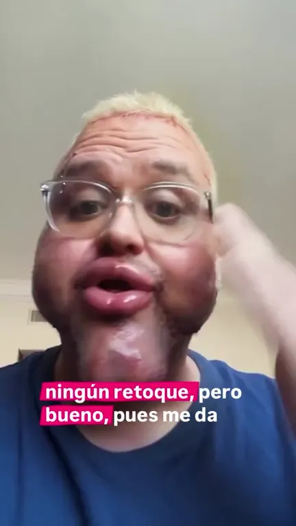 Pablo Ballester con la cara hinchada tras una cirugía estética ficticia, sketch generado con IA